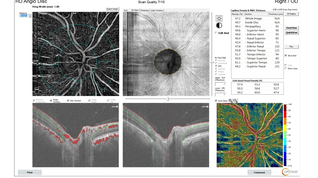 OCTA Scan showing the blood flow at optic nerve head.